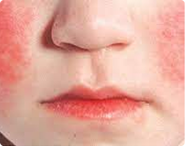 Parvovirus B19 aka Fifth disease